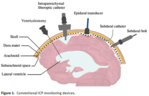 On the Feasibility of a Liquid Crystal Polymer Pressure Sensor for Intracranial Pressure Measurement