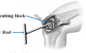 Kinematics Comparison Tool for Alignment Adjusting in Total Knee Replacement Surgical Planning