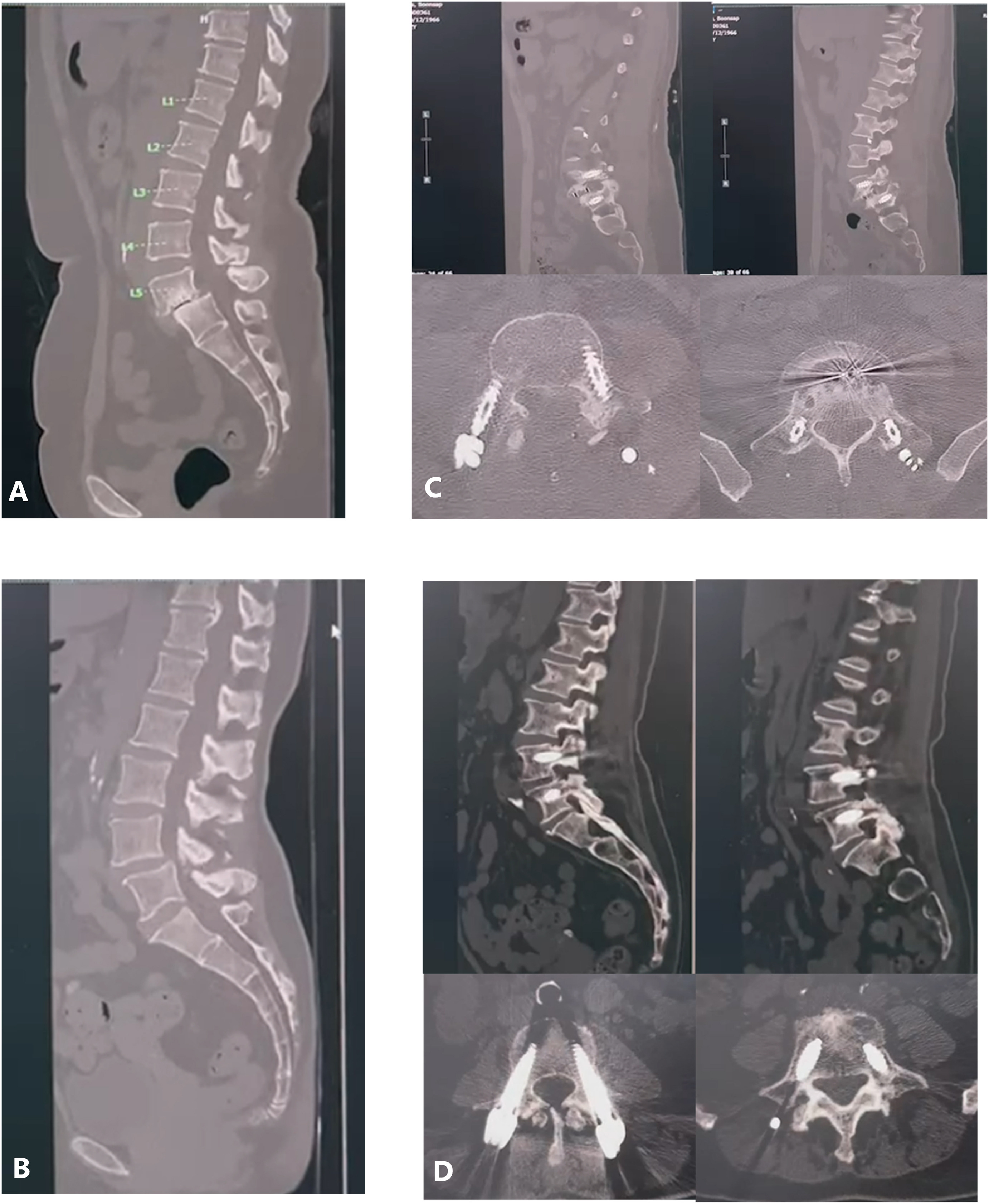 Cost-effectiveness of robotic-assisted spinal surgery: a single-center retrospective study